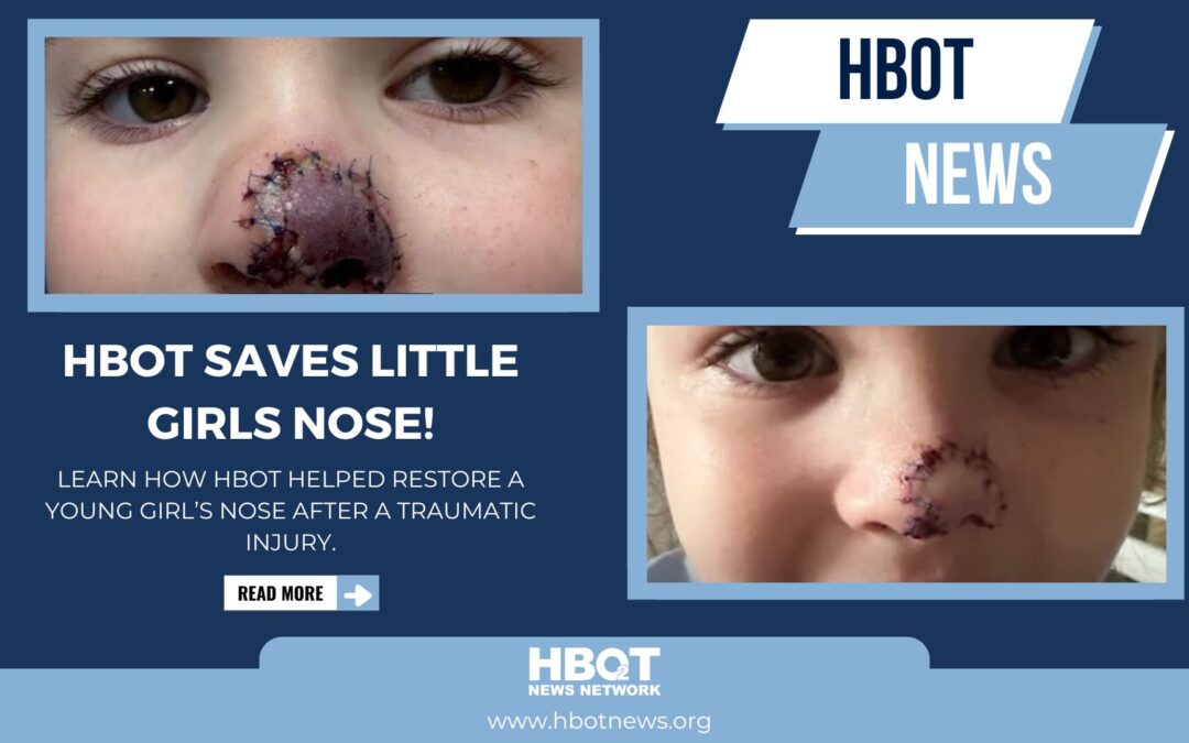 HBOT Saves Girl’s Nose: The Science Explained